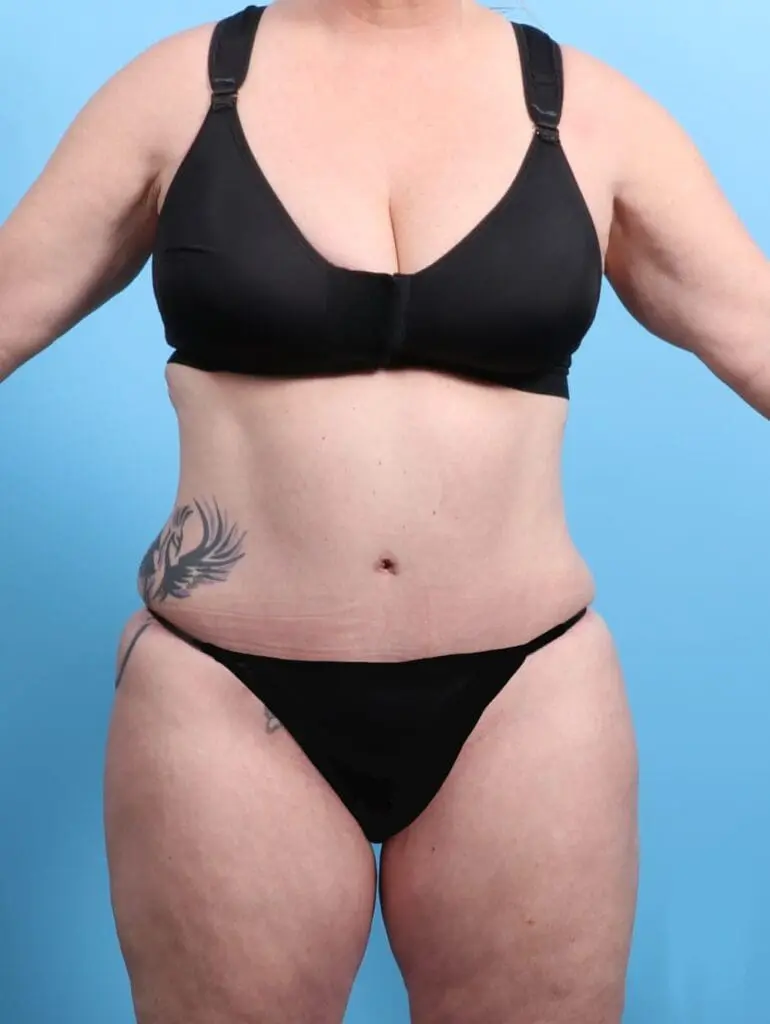 After Weight Loss - Case 21399 - After