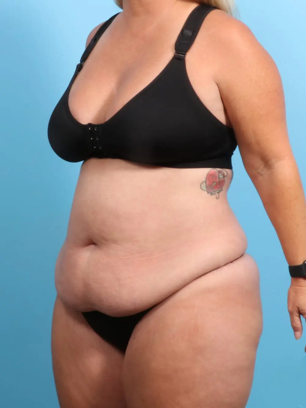 After Weight Loss Patient Photo - Case 21399 - before view-1