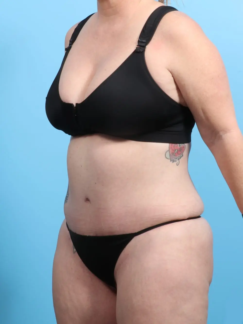 After Weight Loss Patient Photo - Case 21399 - after view-1