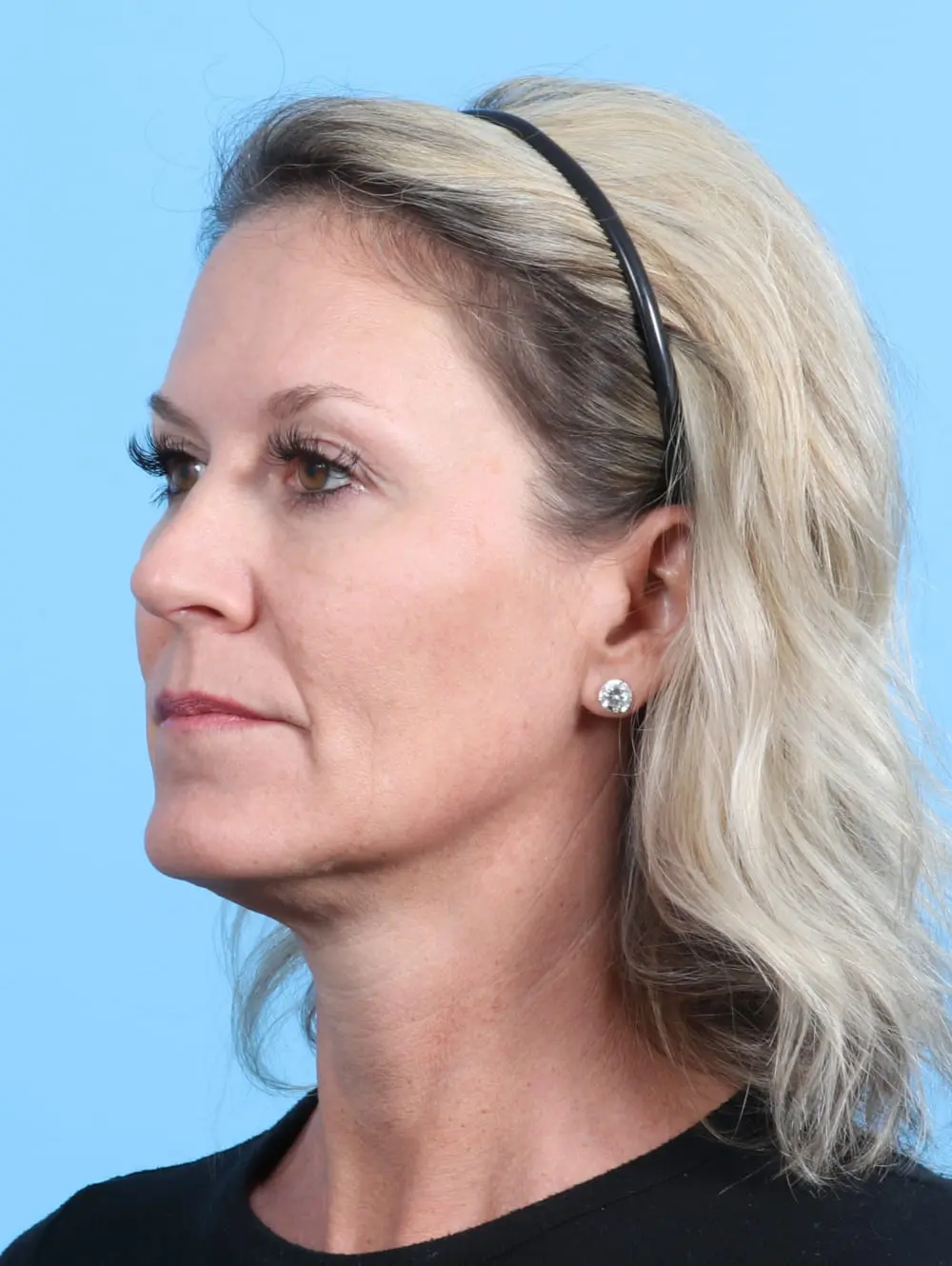 Rhinoplasty Patient Photo - Case 21409 - after view-2