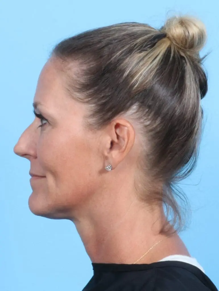 Rhinoplasty - Case 21409 - Before