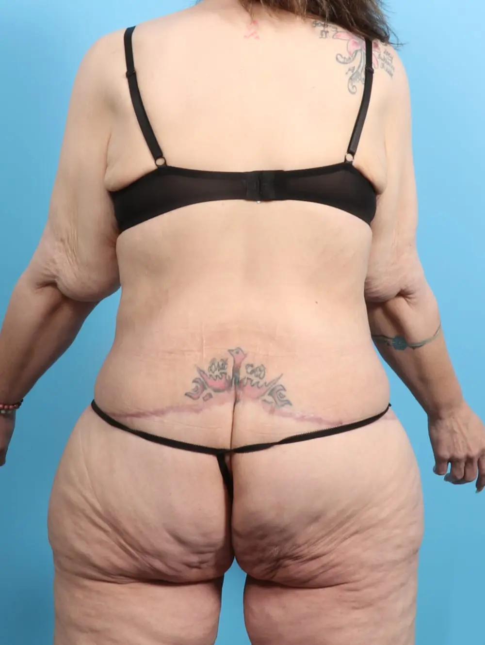 After Weight Loss Patient Photo - Case 21467 - after view-3