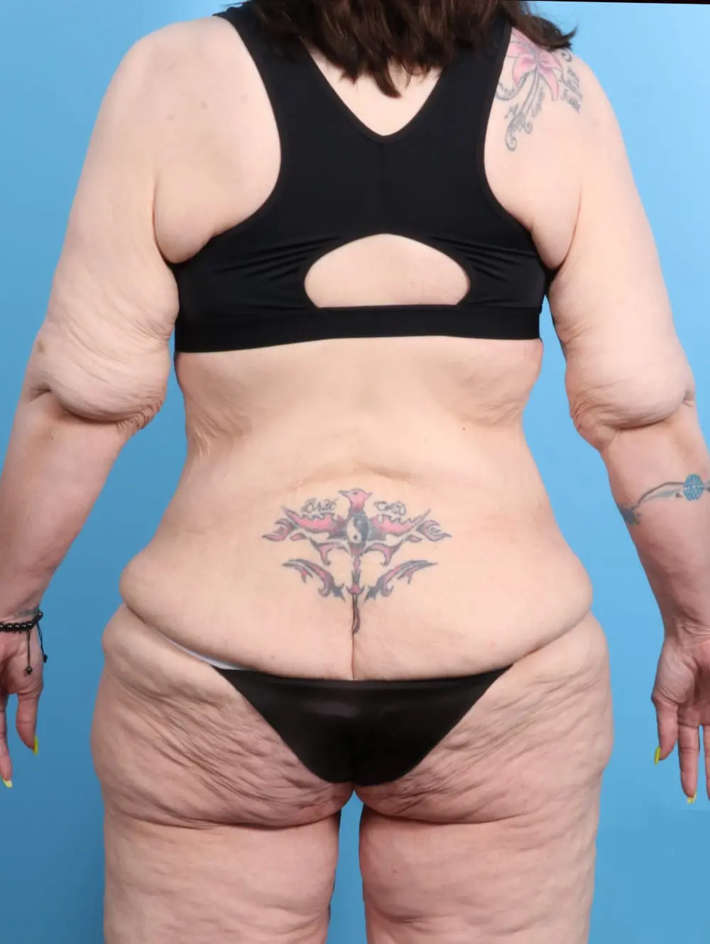 After Weight Loss Patient Photo - Case 21467 - before view-3