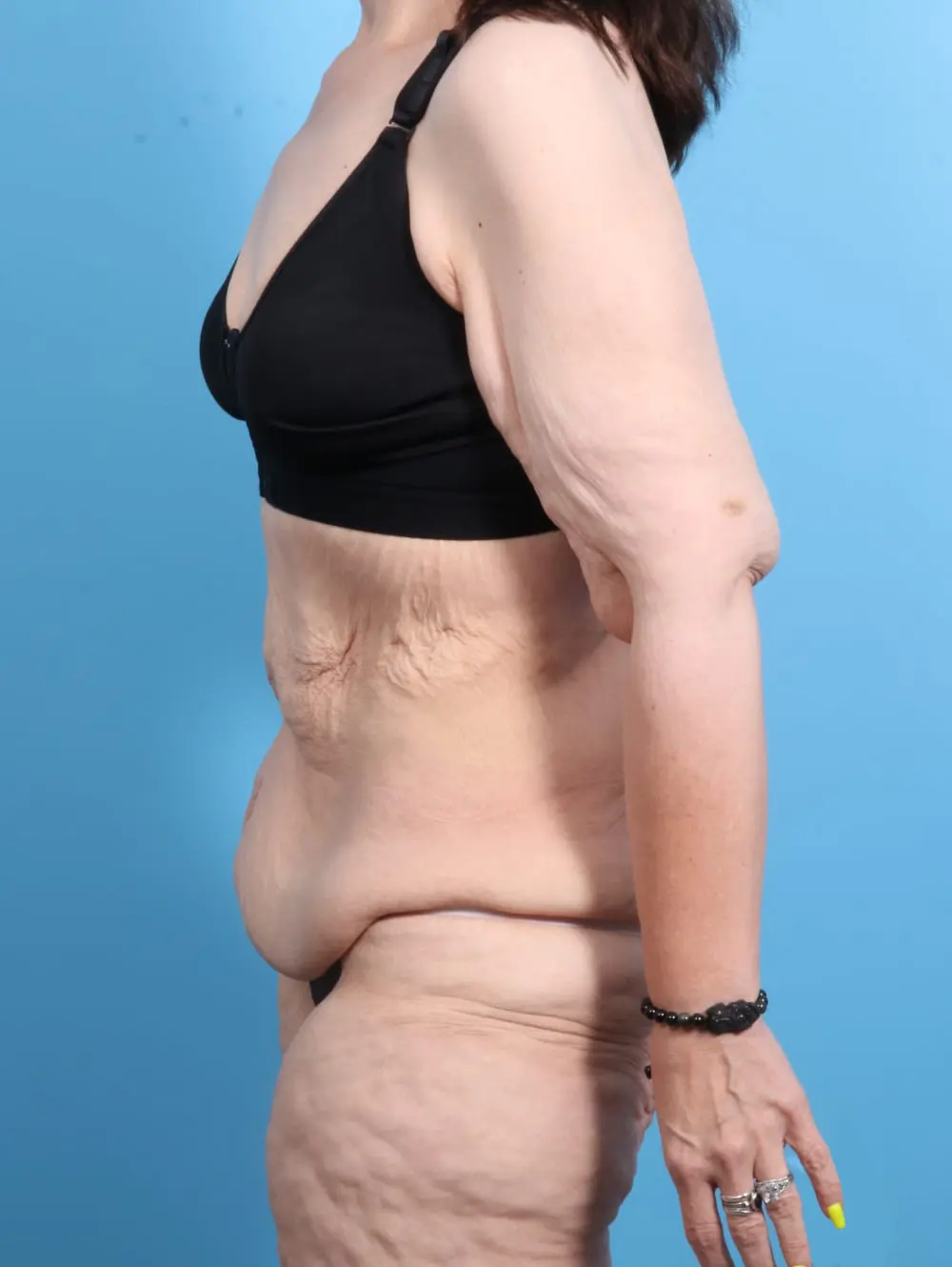 After Weight Loss Patient Photo - Case 21467 - before view-2
