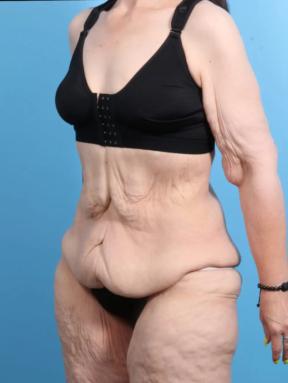 After Weight Loss Patient Photo - Case 21467 - before view-1