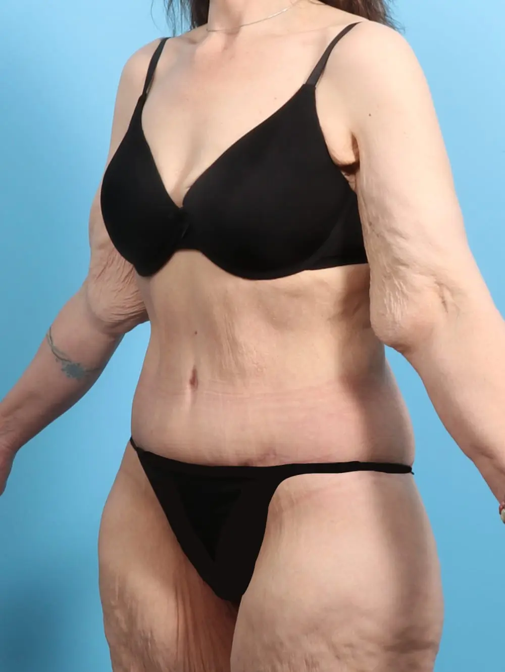 After Weight Loss Patient Photo - Case 21467 - after view-1