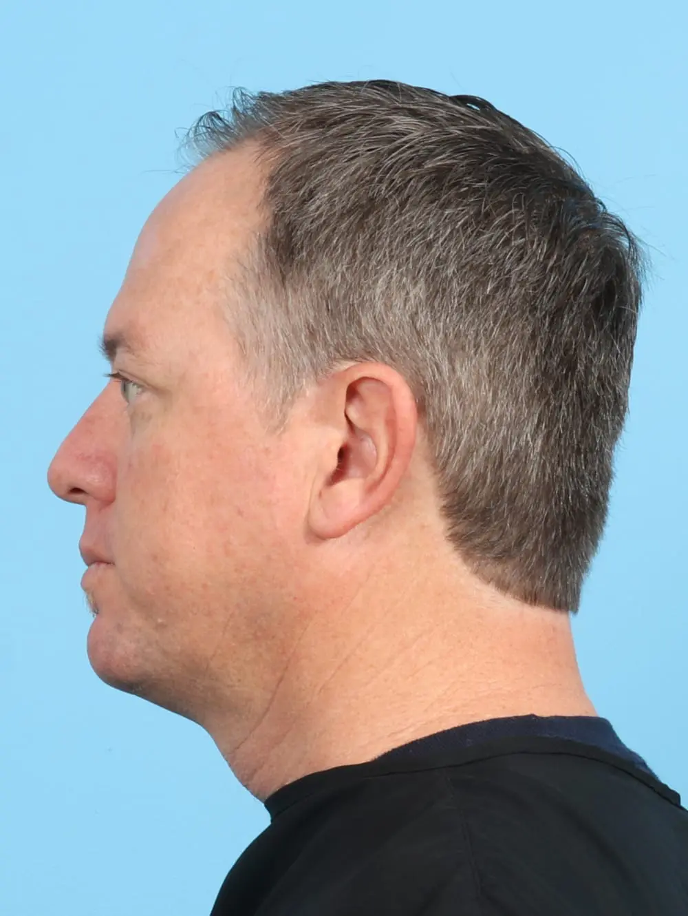 Male Facial Surgery Patient Photo - Case 21493 - after view-2