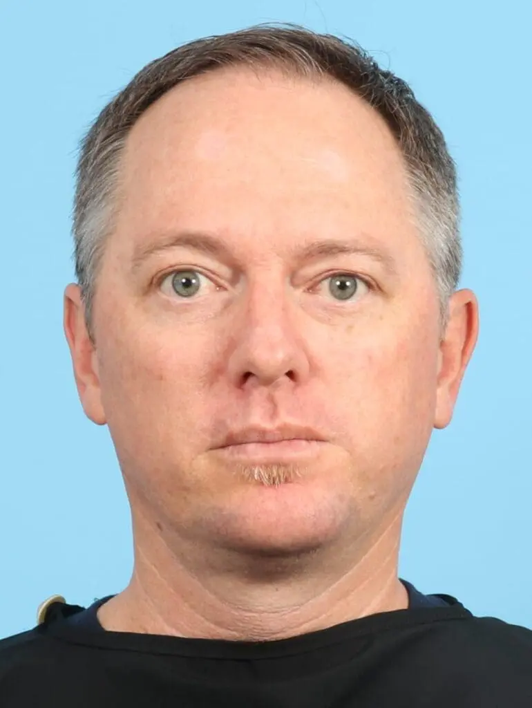 Male Facial Surgery - Case 21493 - After