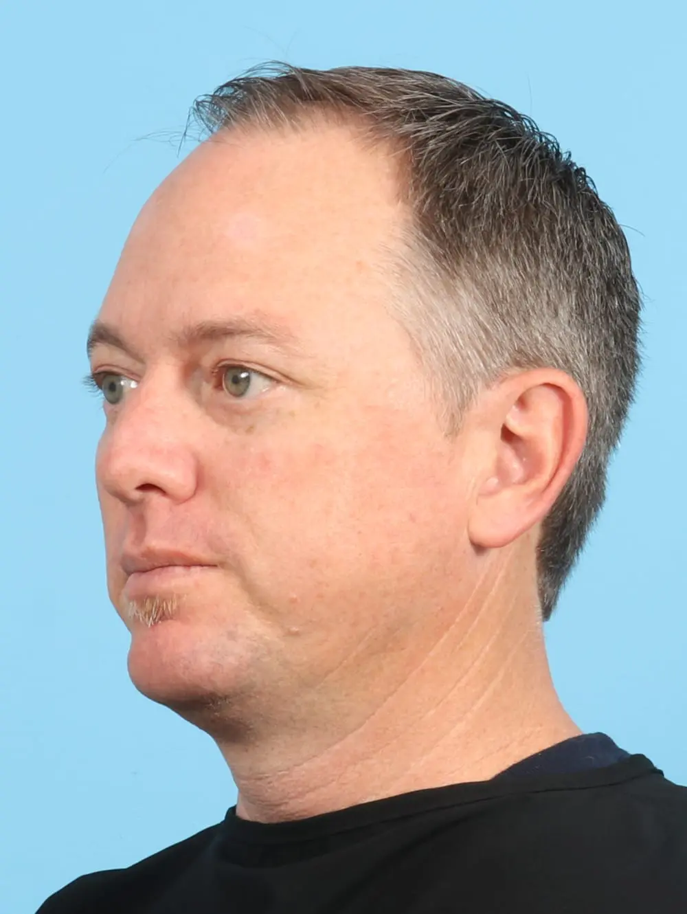 Male Facial Surgery Patient Photo - Case 21493 - after view-1