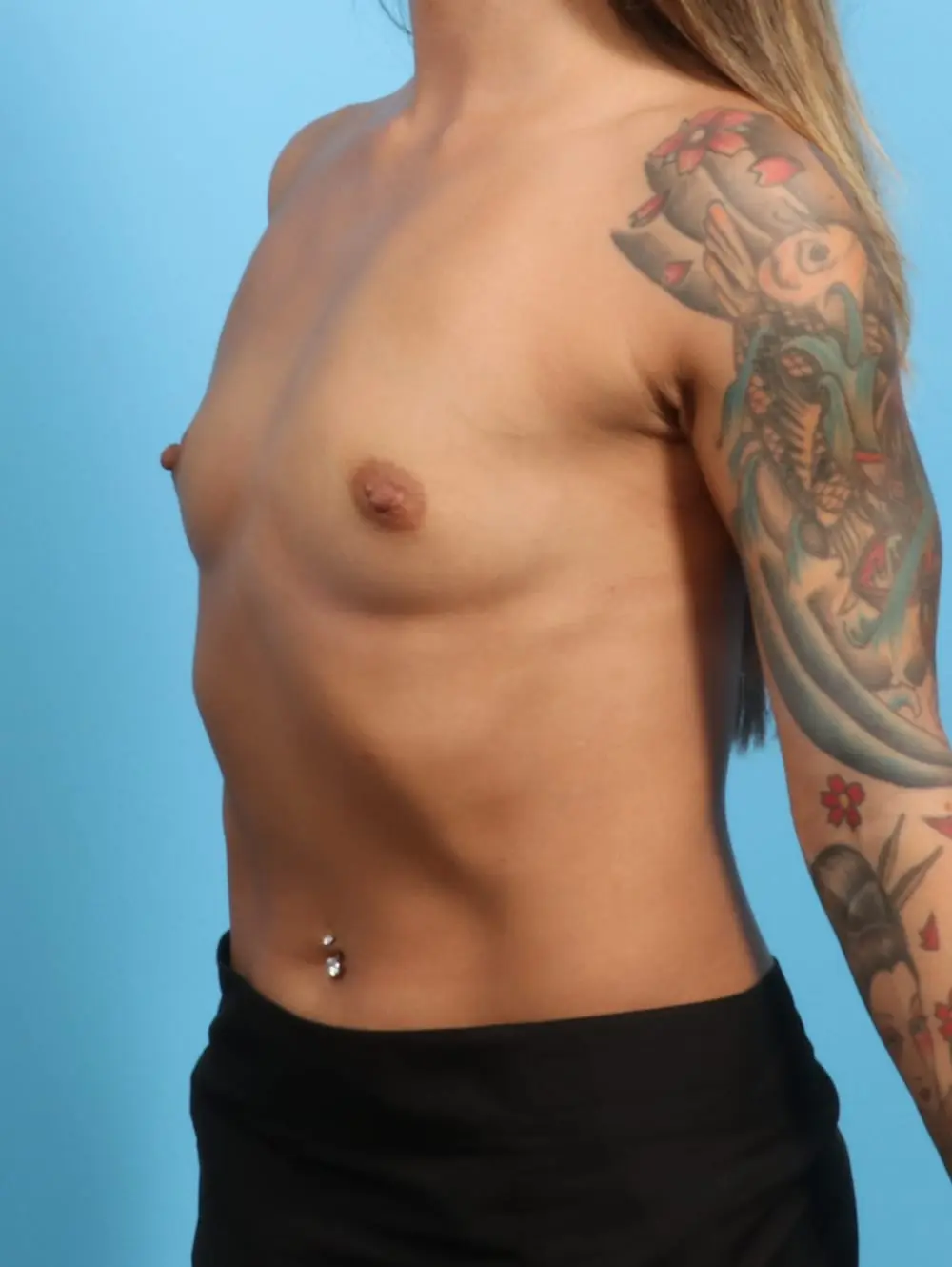 Breast Augmentation Patient Photo - Case 21524 - before view-1