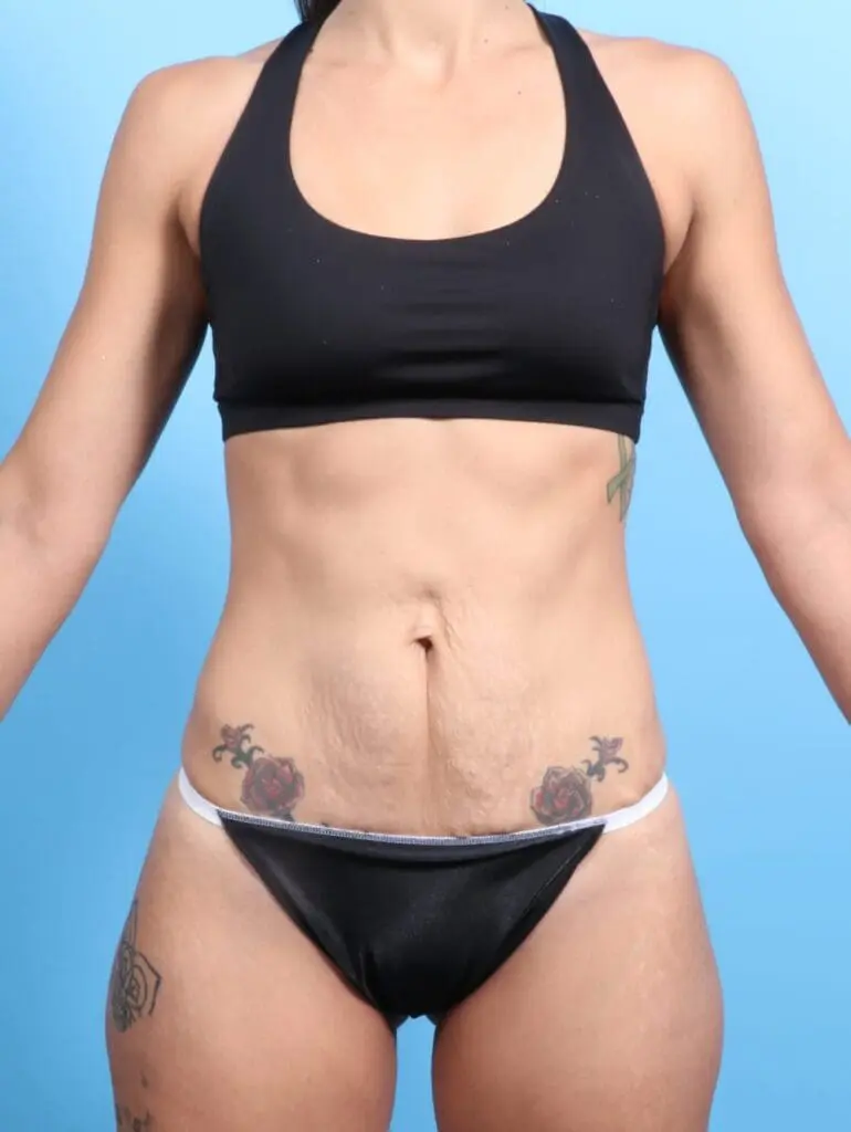Tummy Tuck - Case 21532 - Before