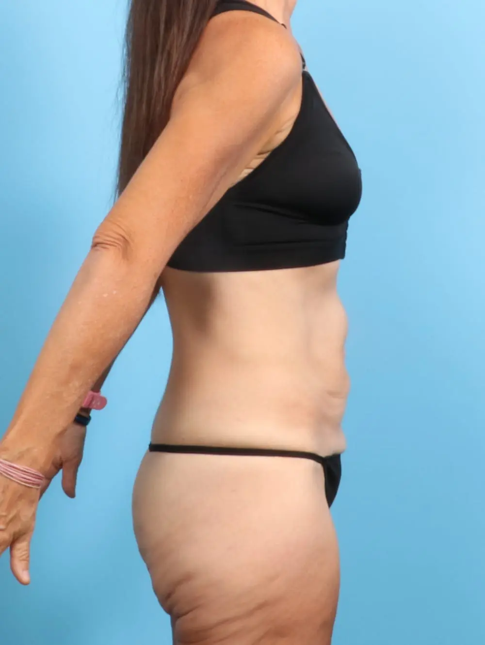 Body Lift Patient Photo - Case 21540 - before view-2