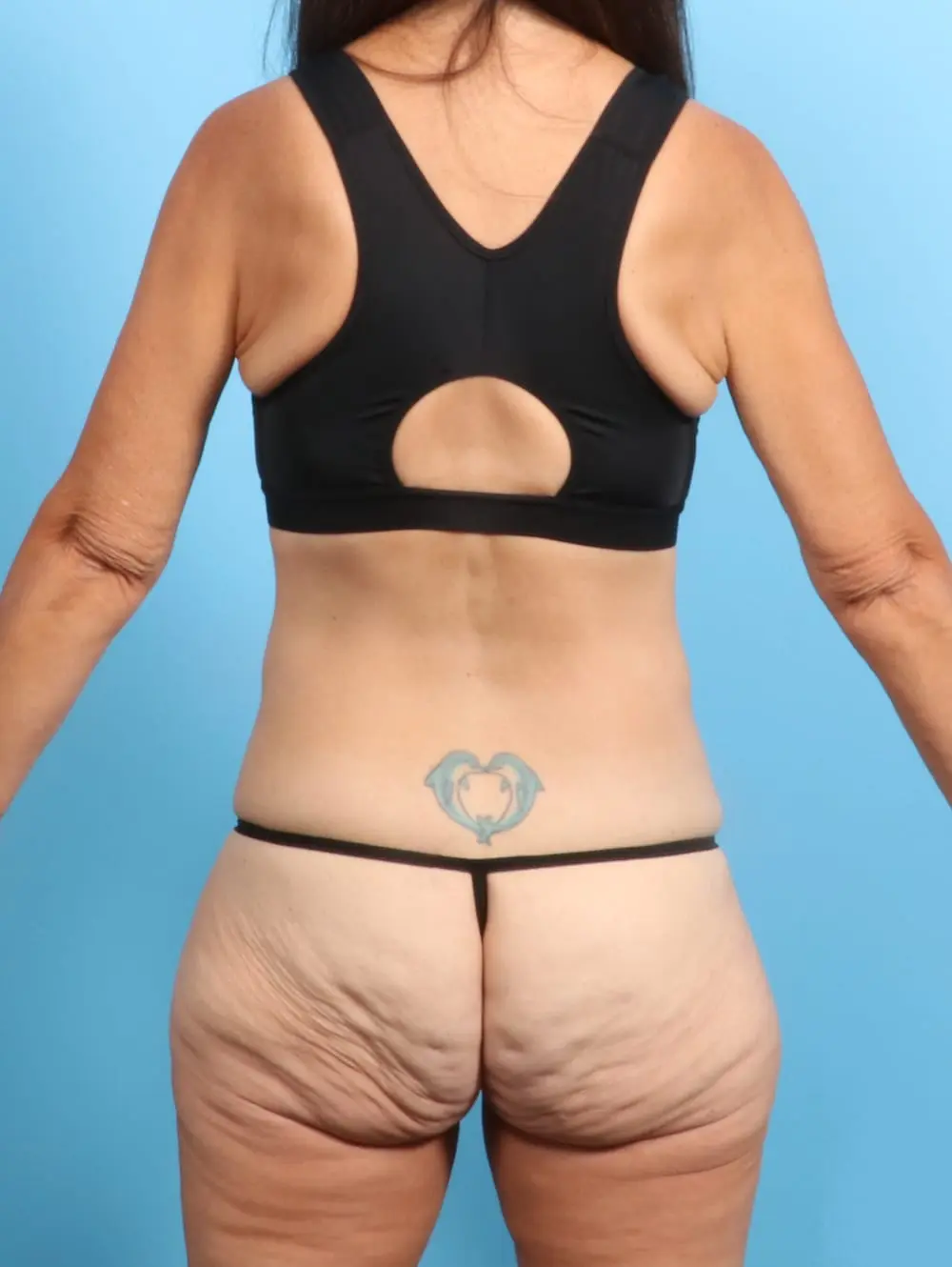 Body Lift Patient Photo - Case 21540 - before view-3