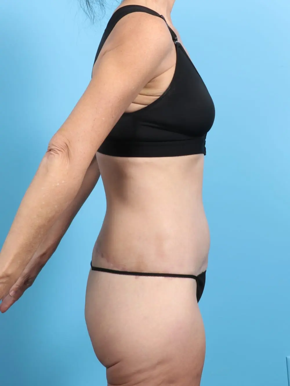 Body Lift Patient Photo - Case 21540 - after view-2