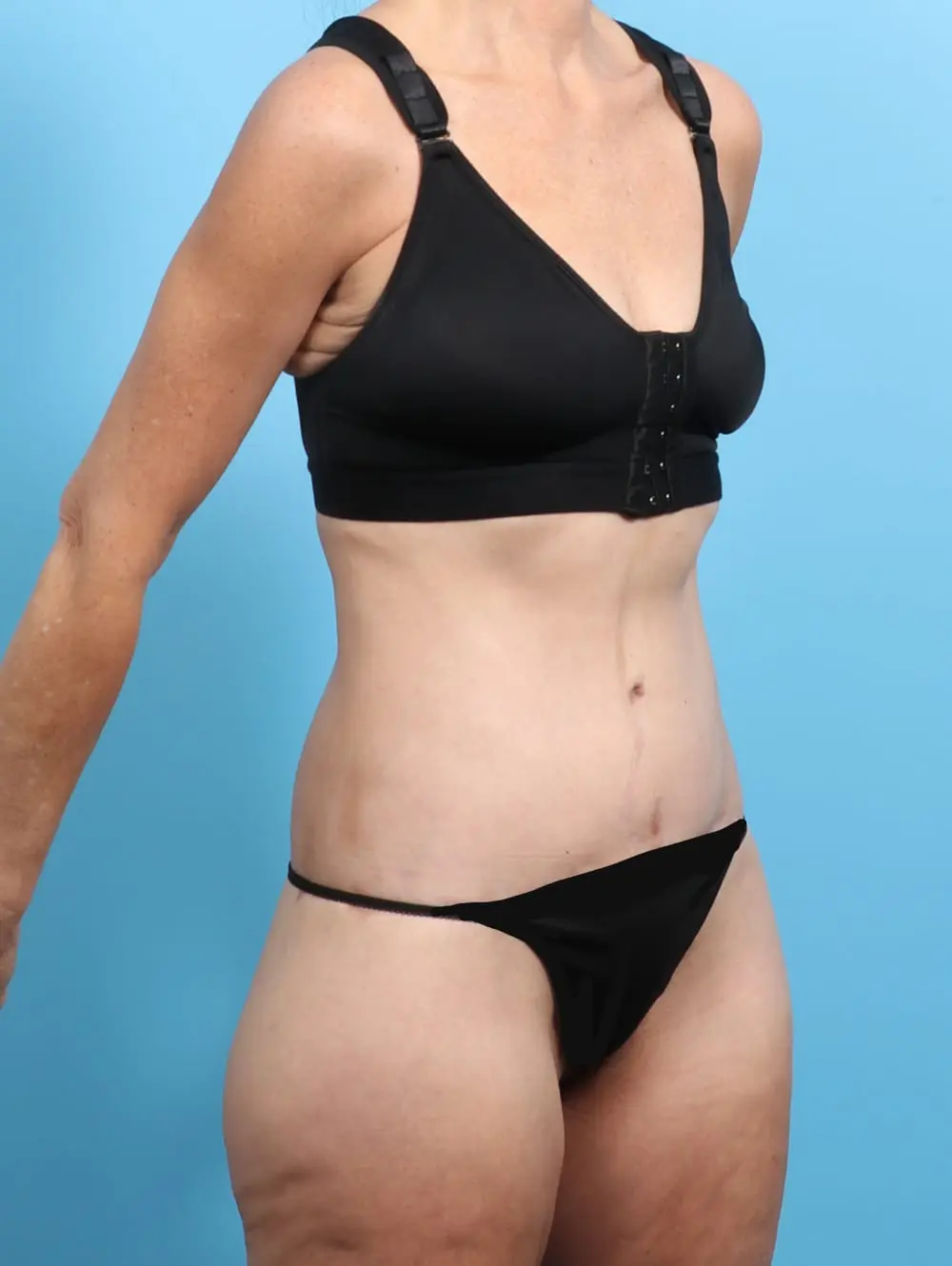 Body Lift Patient Photo - Case 21540 - after view-1