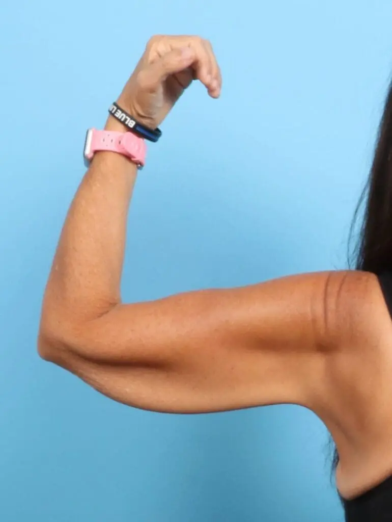 Arm Lift - Case 21550 - Before