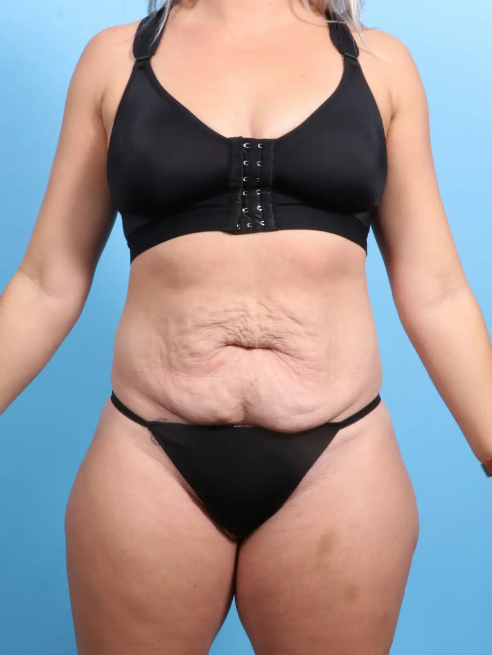 Tummy Tuck Patient Photo - Case 21705 - before view-