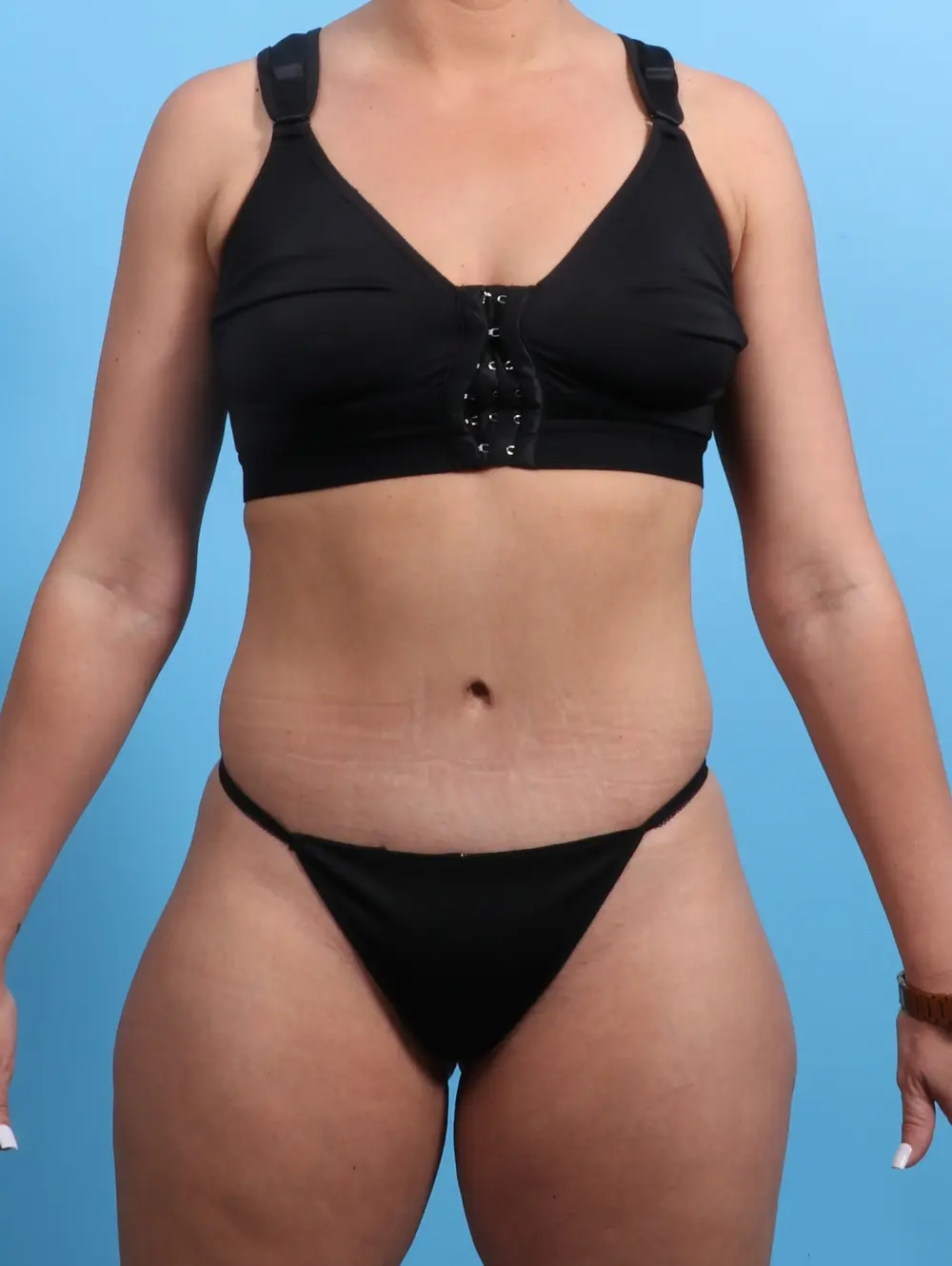 Tummy Tuck Patient Photo - Case 21705 - after view