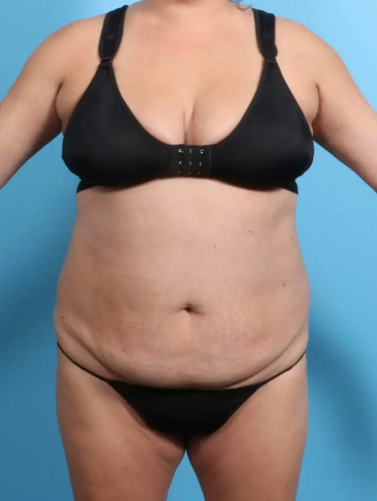 Tummy Tuck - Case 21715 - Before
