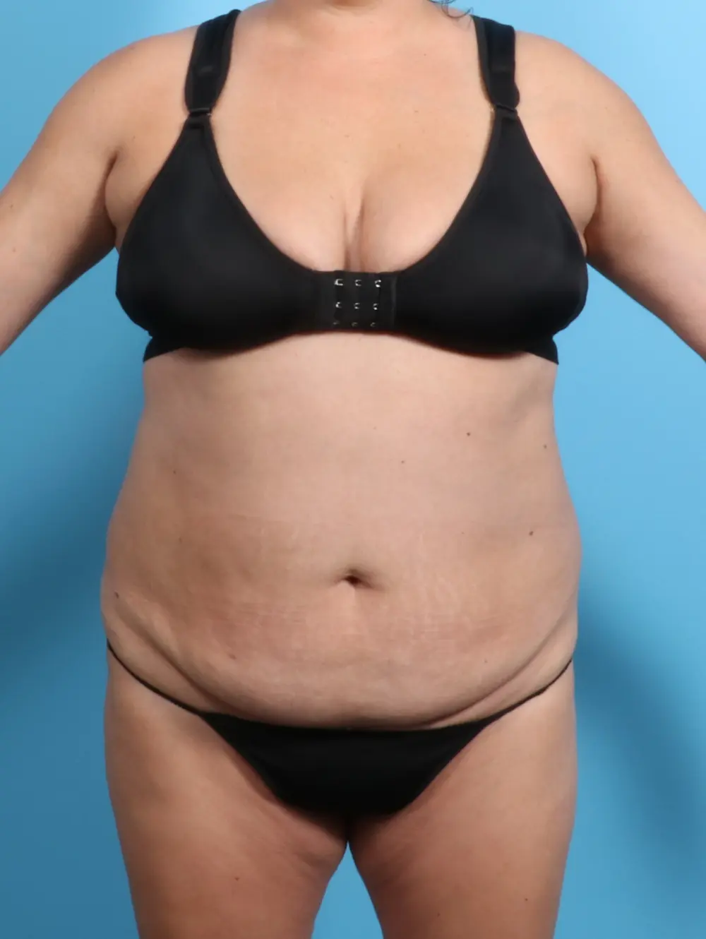 Tummy Tuck Patient Photo - Case 21715 - before view-