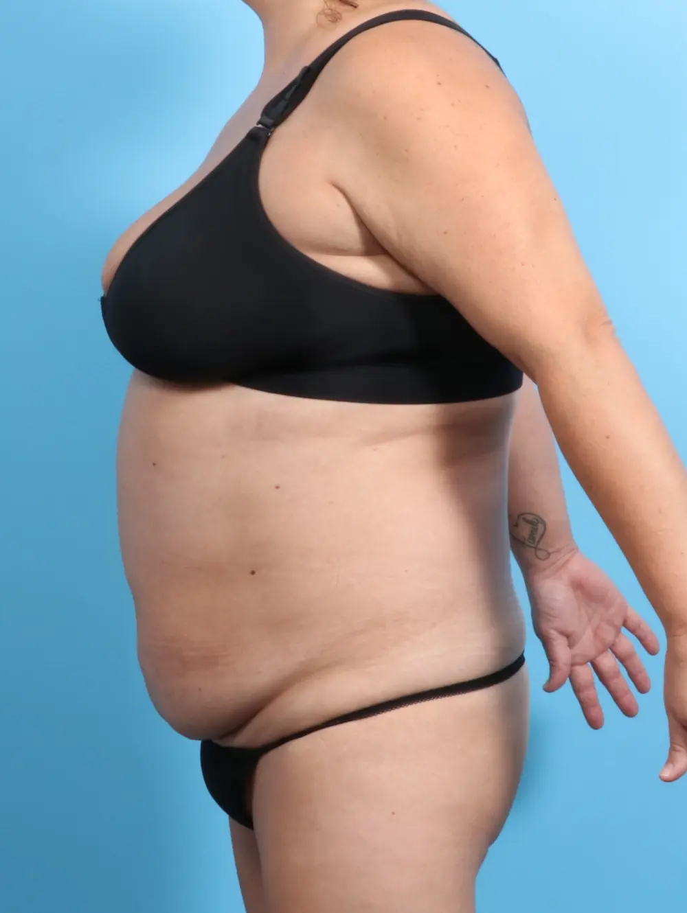Tummy Tuck Patient Photo - Case 21715 - before view-2