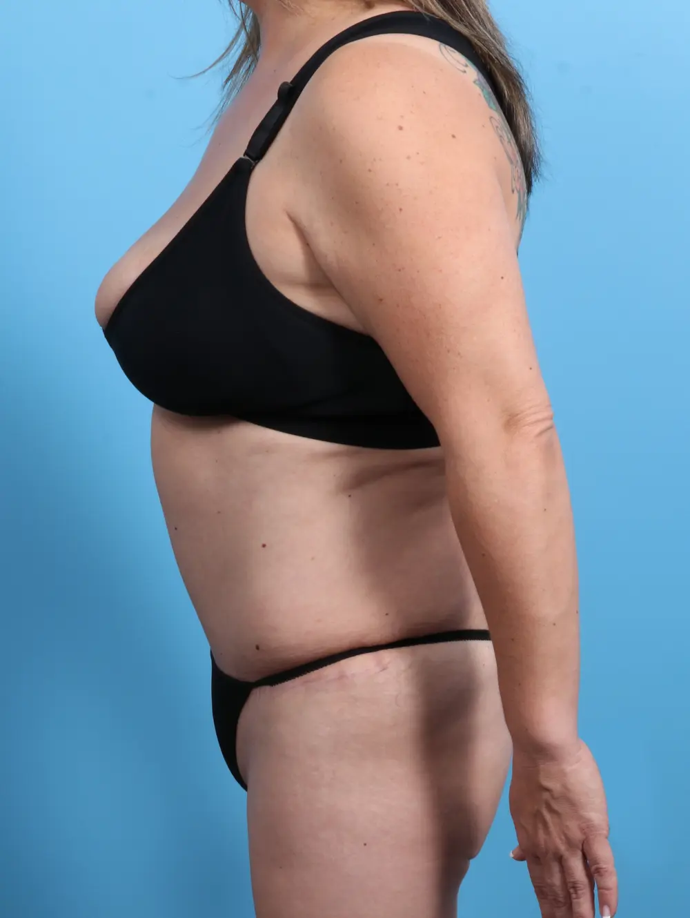 Tummy Tuck Patient Photo - Case 21715 - after view-2