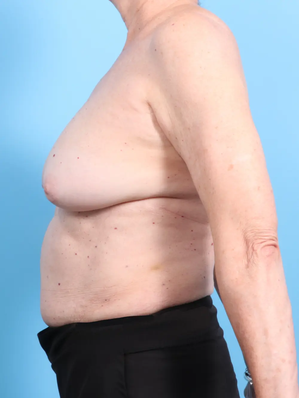 Breast Implant Revision Patient Photo - Case 21729 - before view-2