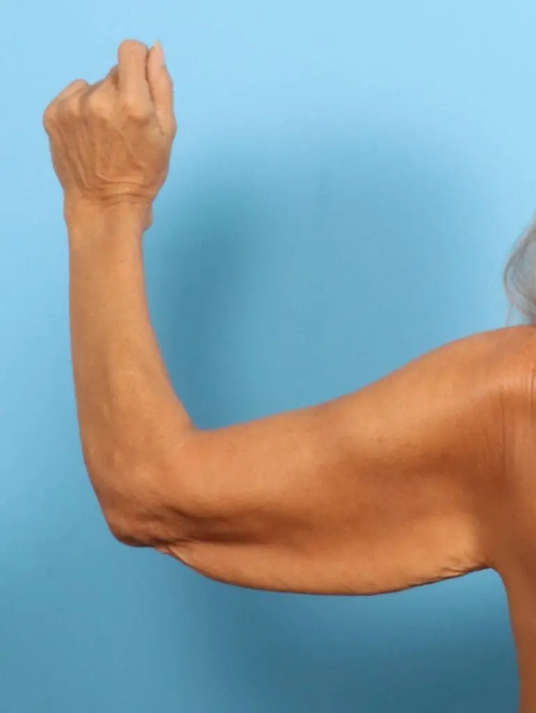 Arm Lift - Case 21737 - Before