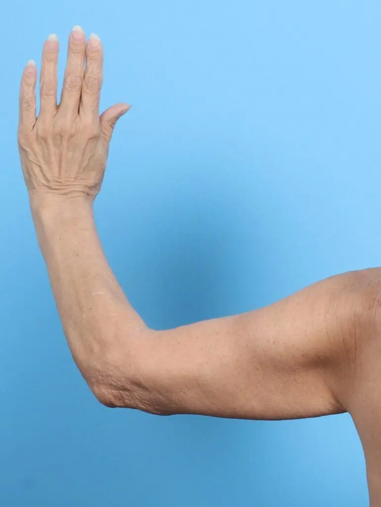 Arm Lift - Case 21737 - After