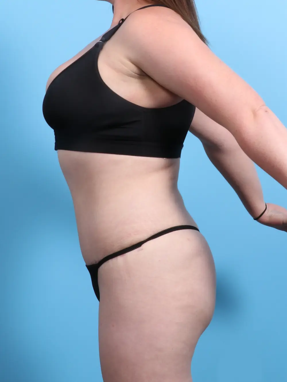 Tummy Tuck Patient Photo - Case 21760 - after view-2