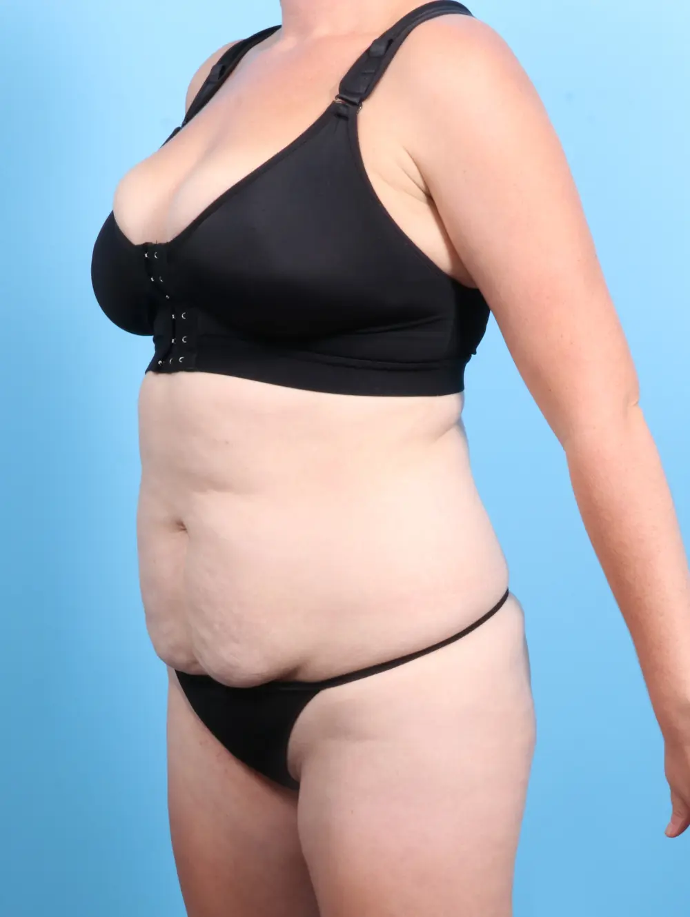 Tummy Tuck Patient Photo - Case 21760 - before view-1