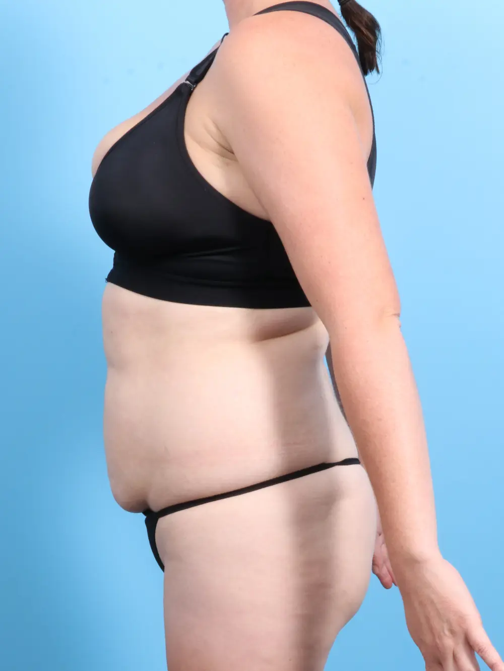 Tummy Tuck Patient Photo - Case 21760 - before view-2