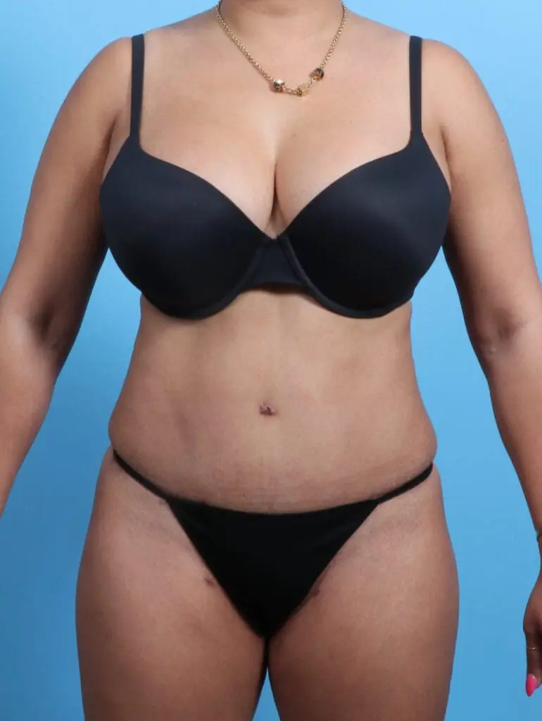Tummy Tuck - Case 21768 - After