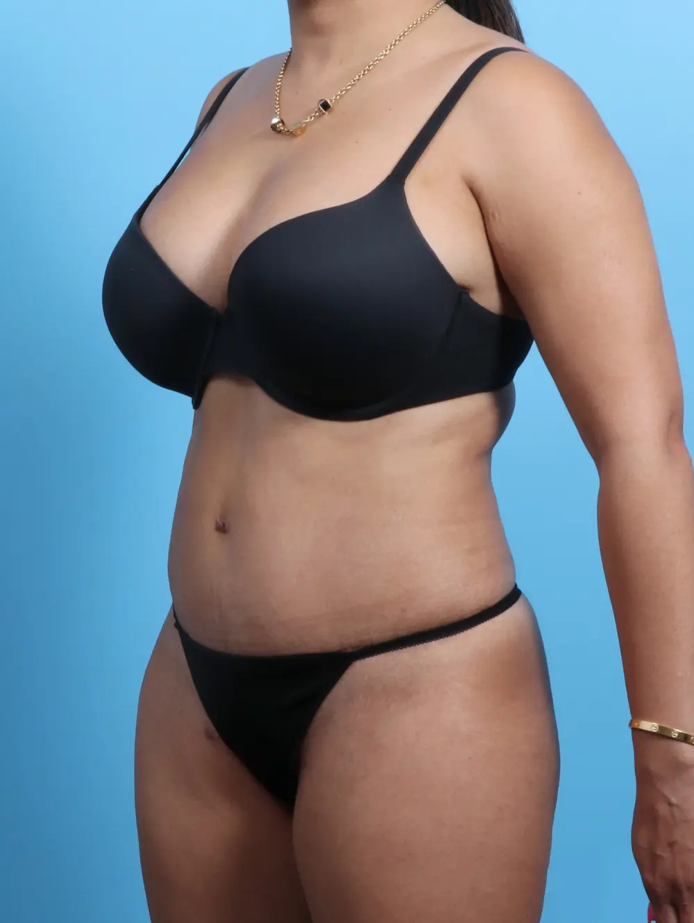 Tummy Tuck Patient Photo - Case 21768 - after view-1