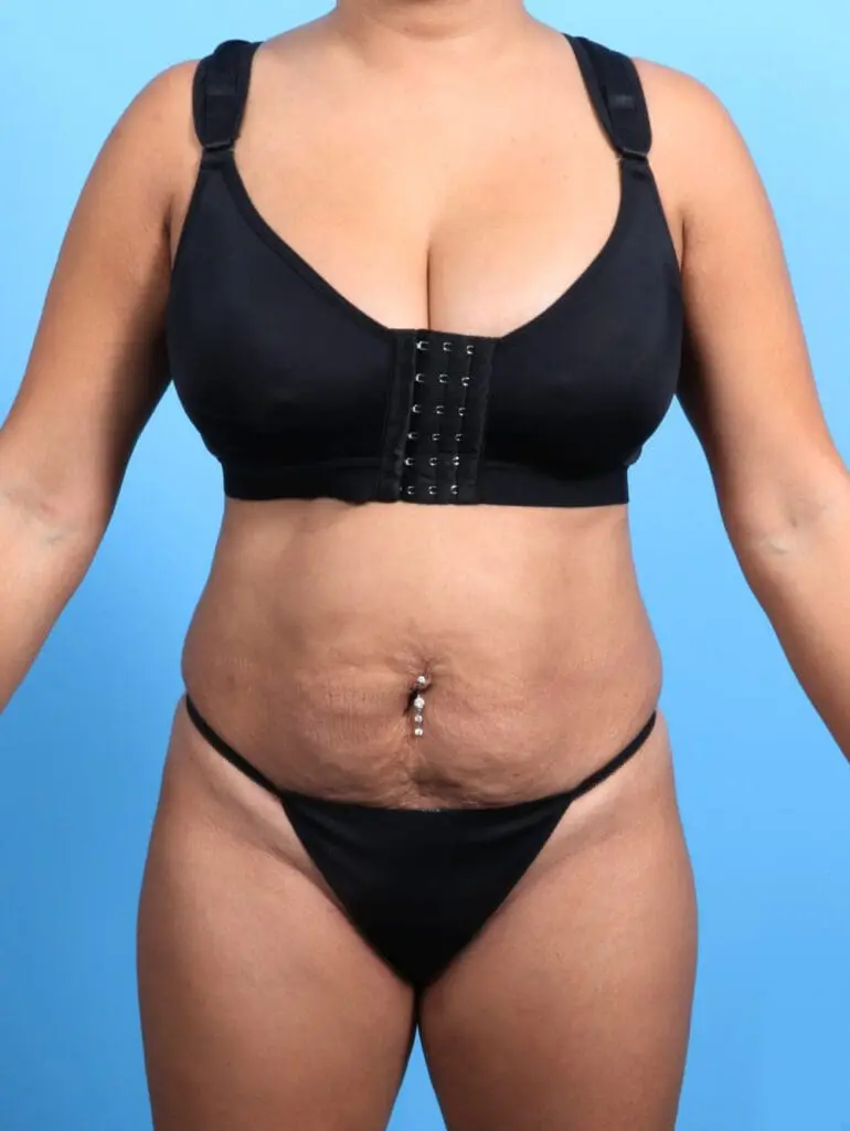 Tummy Tuck - Case 21768 - Before