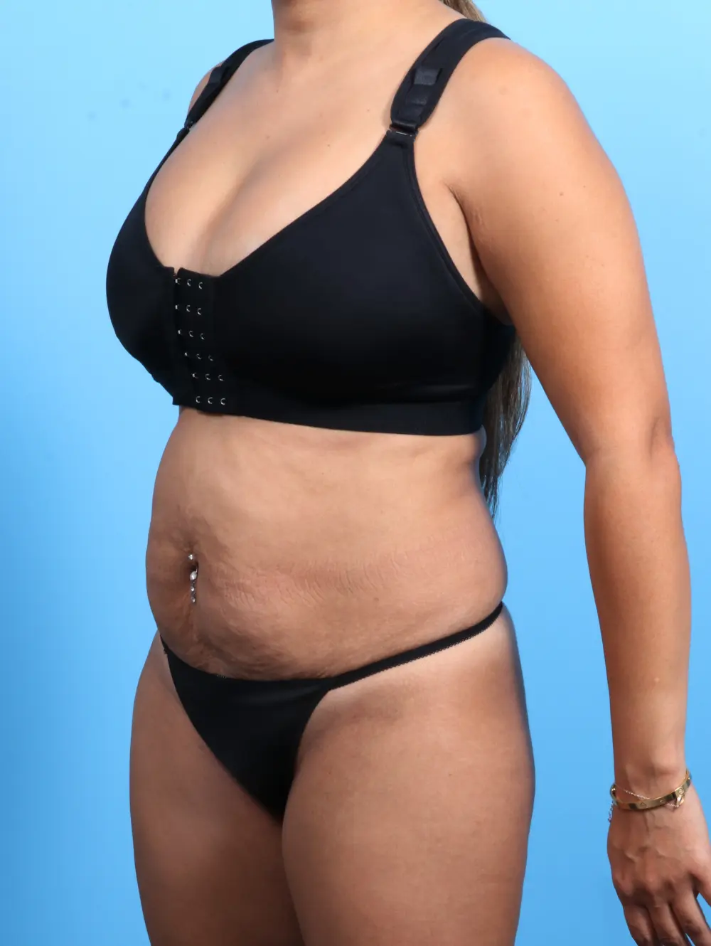 Tummy Tuck Patient Photo - Case 21768 - before view-1