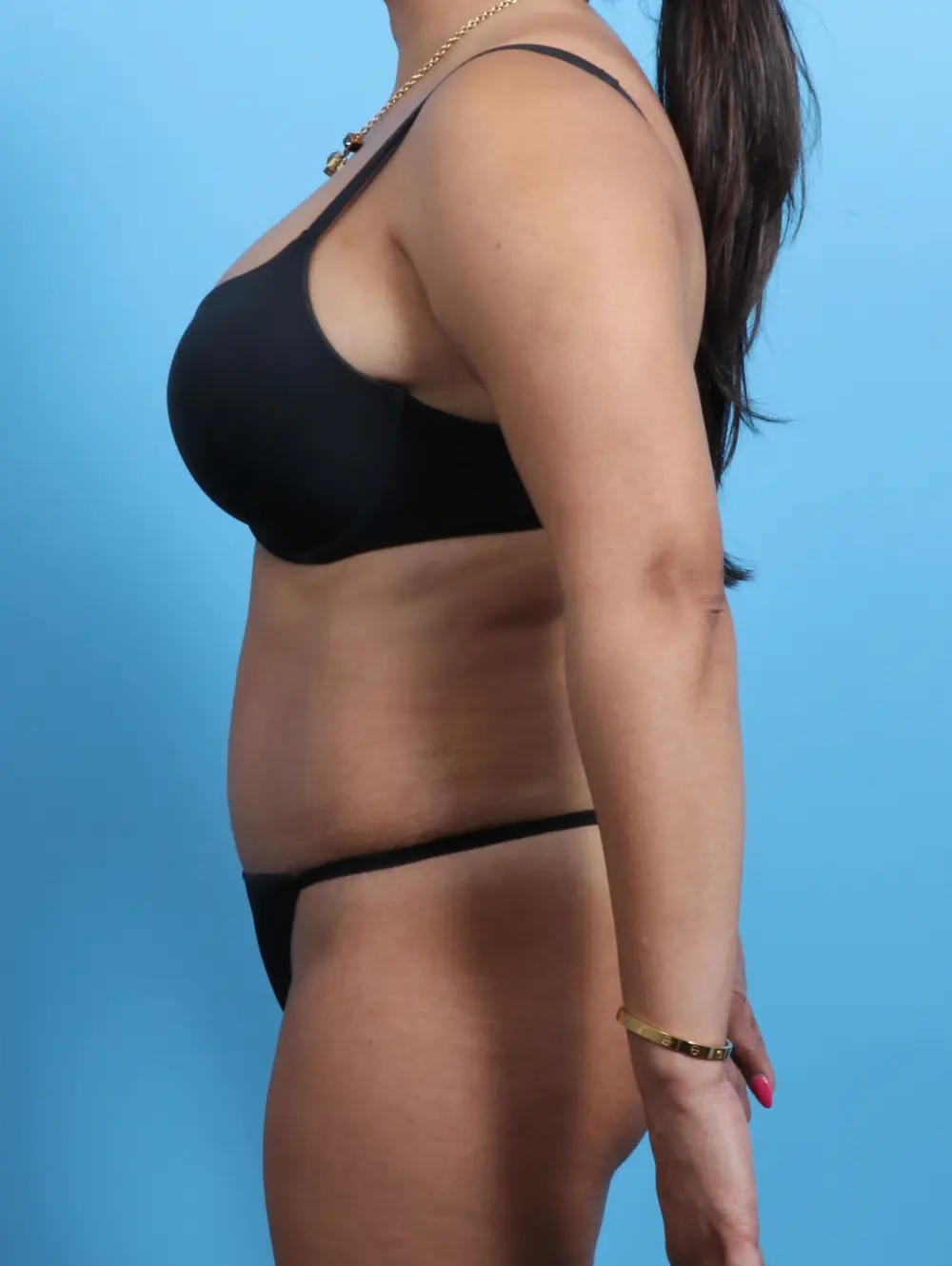 Tummy Tuck Patient Photo - Case 21768 - after view-2