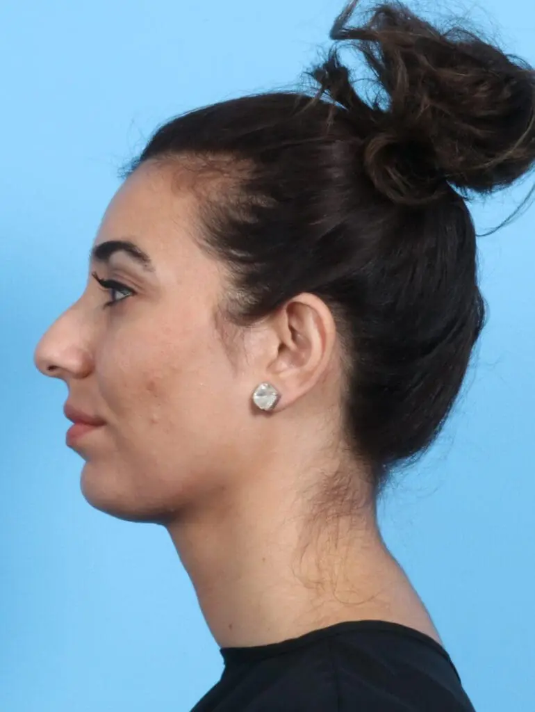 Rhinoplasty - Case 21792 - Before