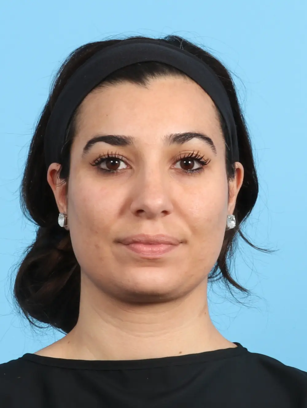 Rhinoplasty Patient Photo - Case 21792 - after view-1