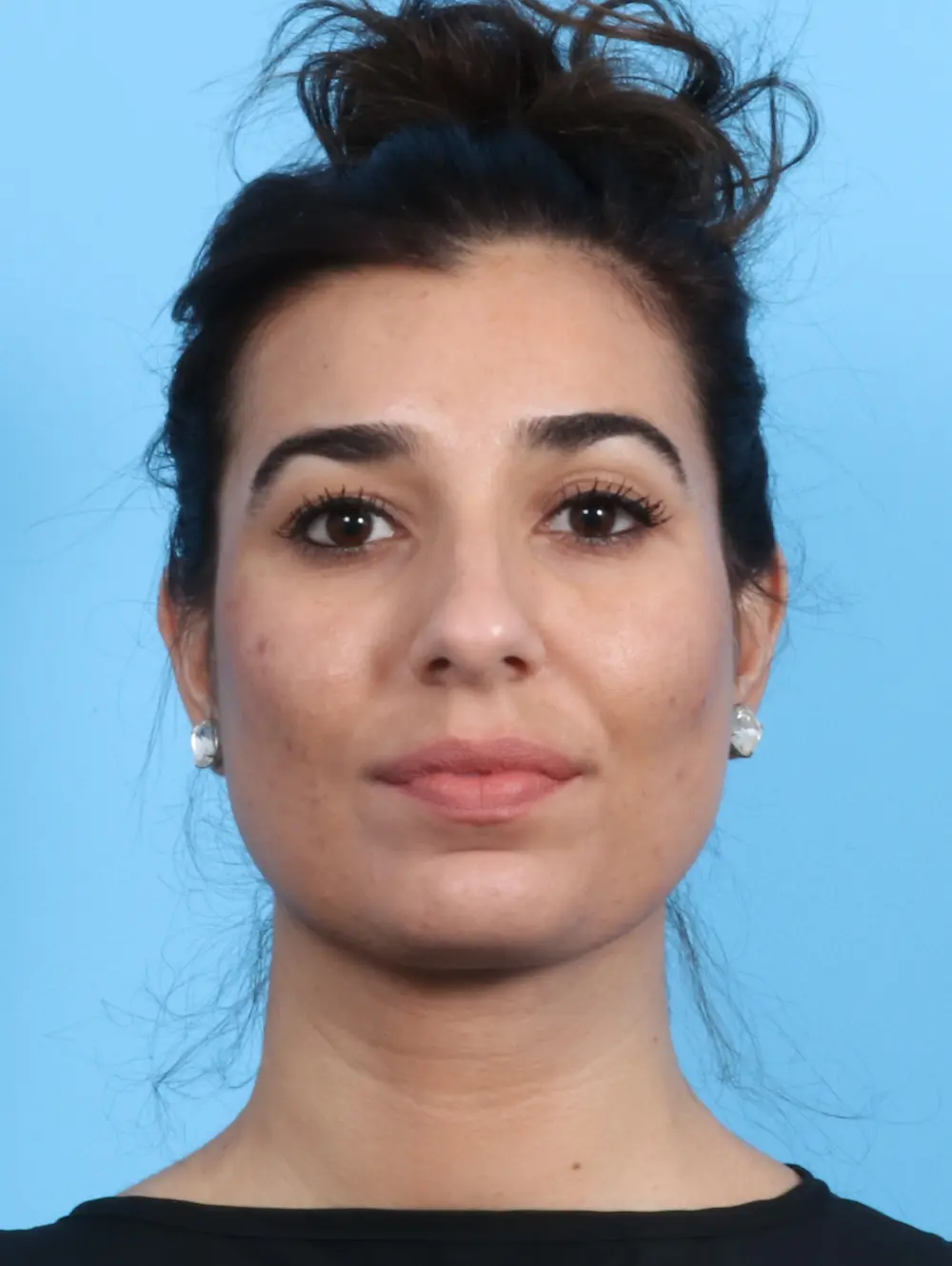 Rhinoplasty Patient Photo - Case 21792 - before view-1