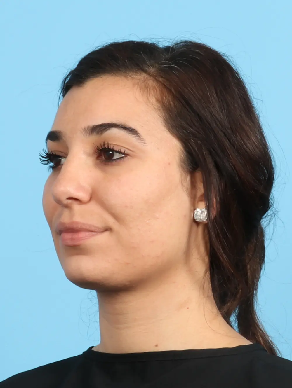 Rhinoplasty Patient Photo - Case 21792 - after view-2