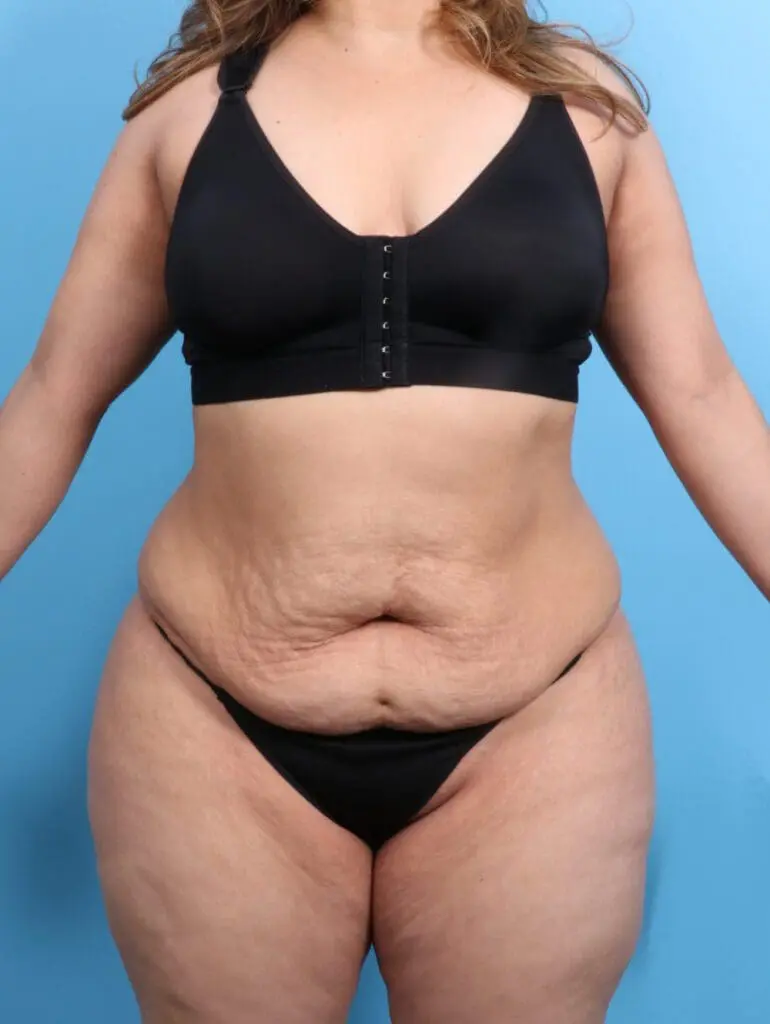 Tummy Tuck - Case 21818 - Before