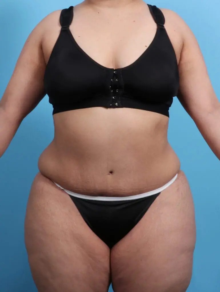 Tummy Tuck - Case 21818 - After