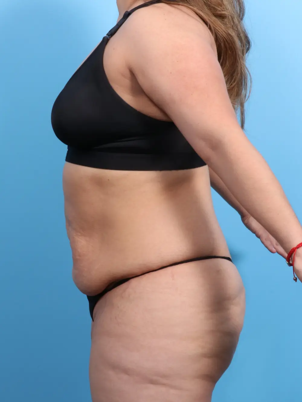 Tummy Tuck Patient Photo - Case 21818 - before view-2