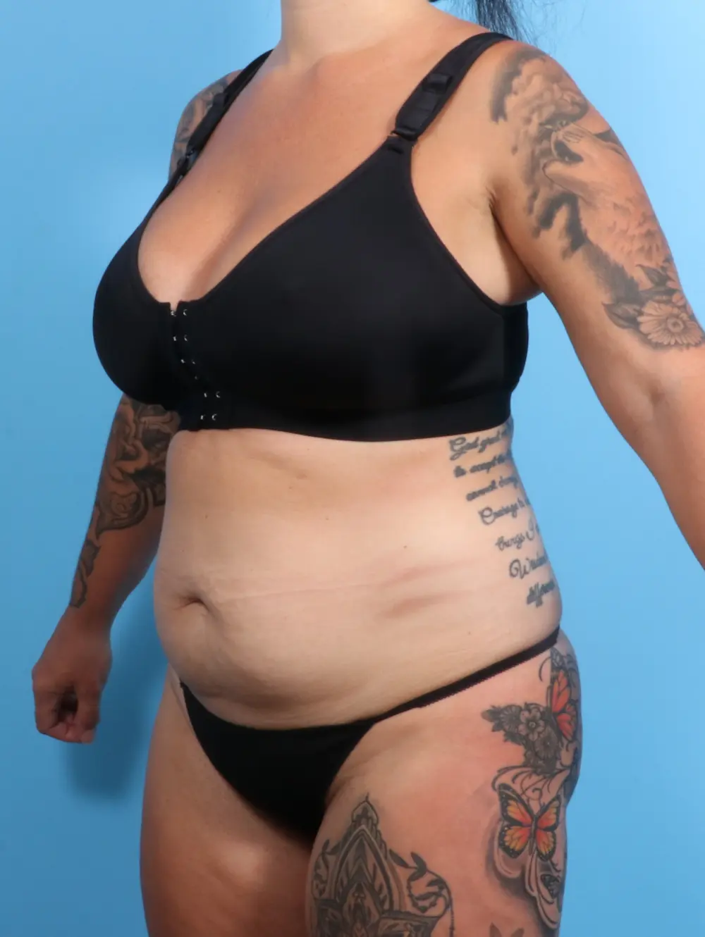 Tummy Tuck Patient Photo - Case 21826 - before view-1