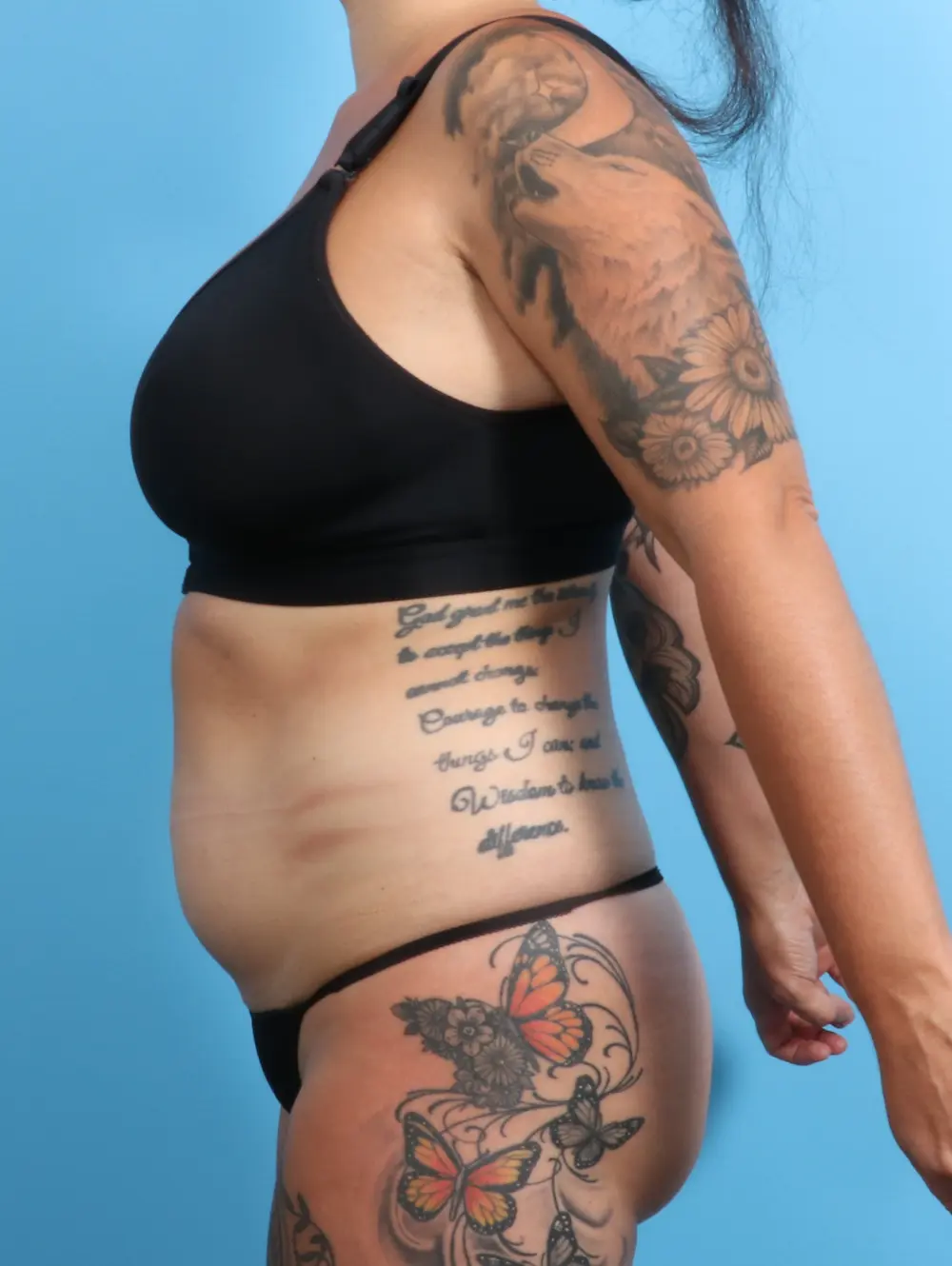 Tummy Tuck Patient Photo - Case 21826 - before view-2