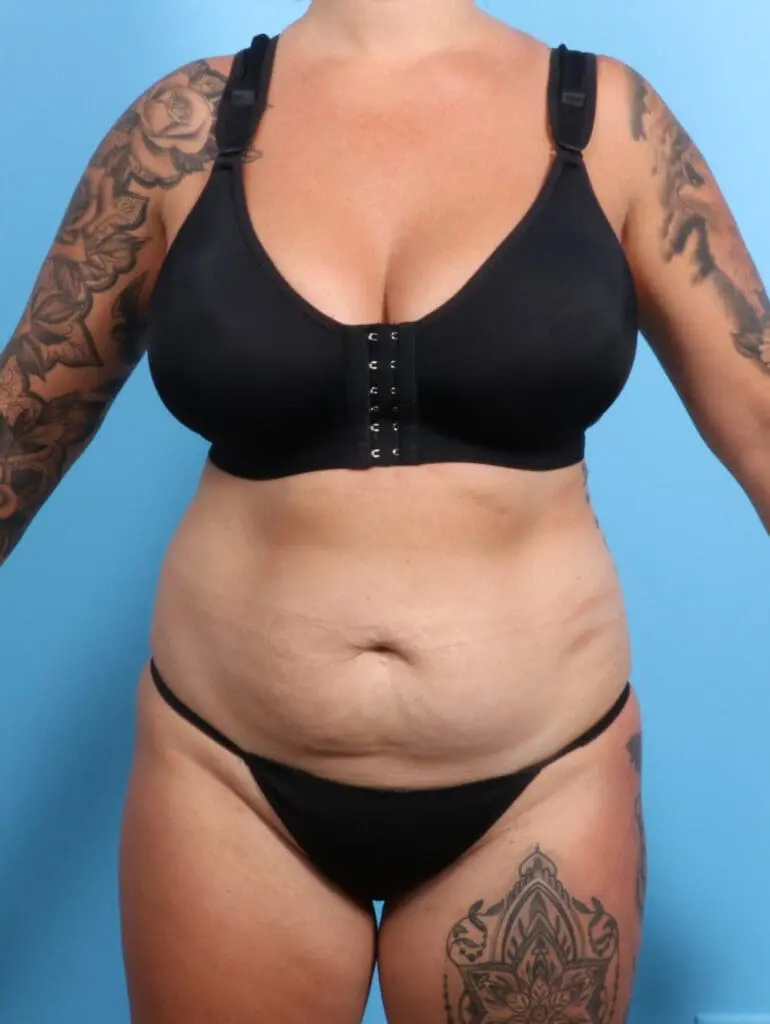 Tummy Tuck - Case 21826 - Before