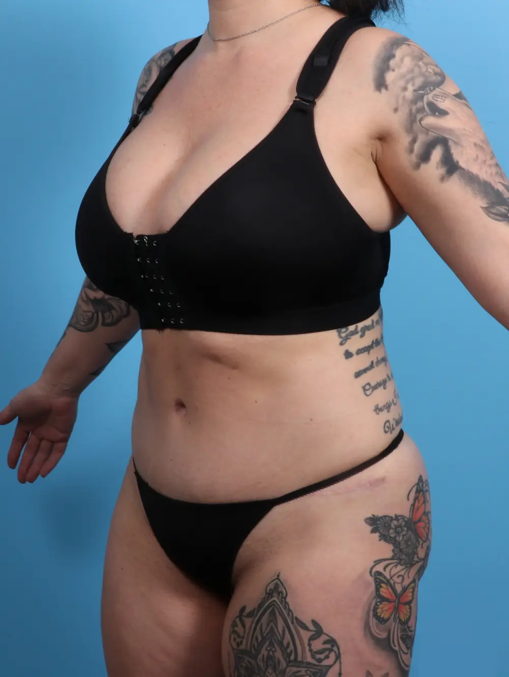 Tummy Tuck Patient Photo - Case 21826 - after view-1