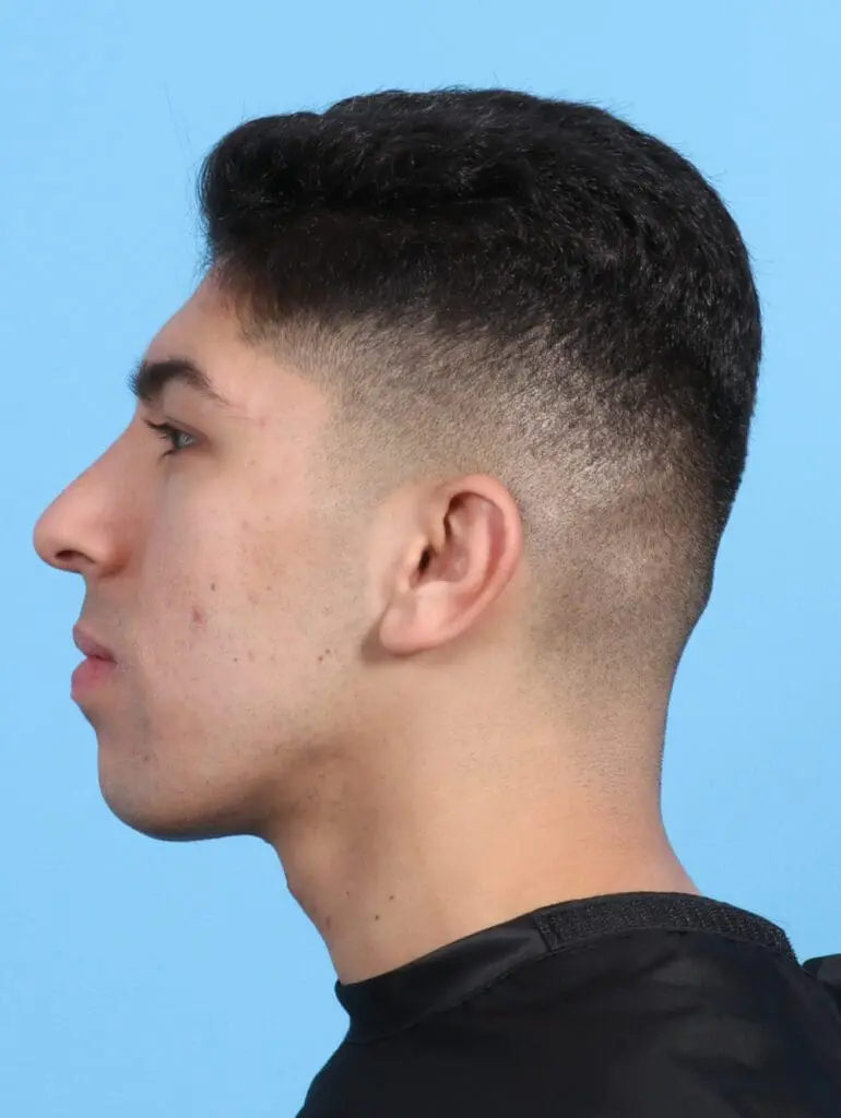 Male Facial Surgery - Case 21884 - After