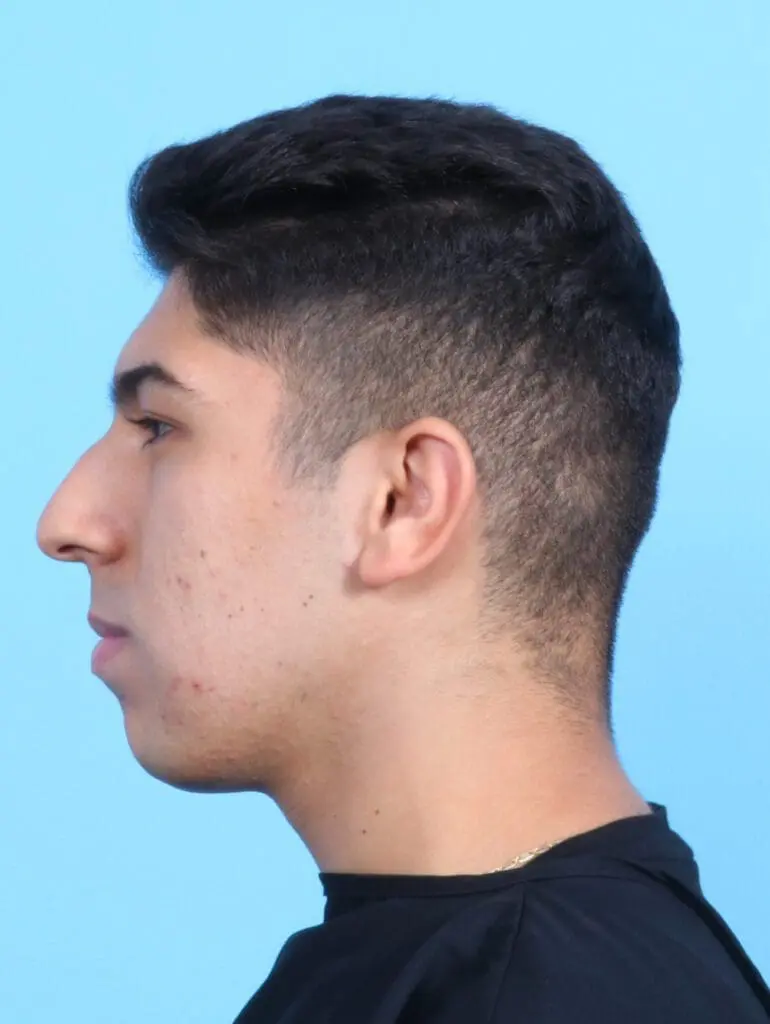 Male Facial Surgery - Case 21884 - Before